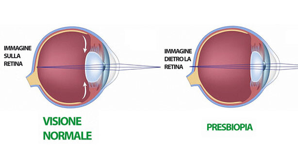 La Presbiopia Oculus Centro Oculistico Laser