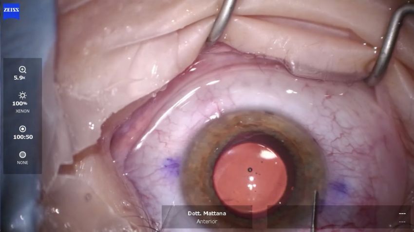 Impianto Di Lenti Fachiche ICL Caso 2 Oculus Centro Oculistico Laser