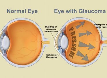 Laser SLT e Impianto di Stent XEN la nuova frontiera per la cura del Glaucoma