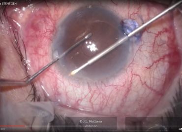 Video Intervento Stent XEN per Glaucoma